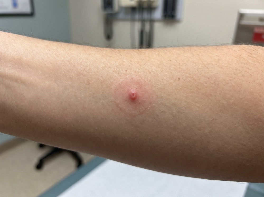 Close-up of a fresh fishing spider bite on skin showing a small red bump with faint puncture marks and mild surrounding redness
